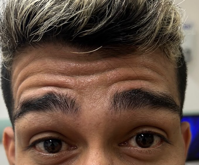 Testa antes da aplicação, franzindo a testa